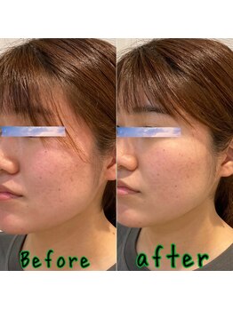 ピエール ナリタイラボ(Piel NARITAI LABO)/小顔と肌