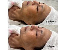 ココ(Coco)/鎮静ミルクピーリング（敏感肌）