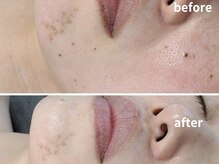 エイプリルプラス(April plus)/光フェイシャル