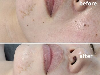 エイプリルプラス(April plus)/光フェイシャル