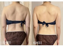 真(sin)/6回の施術で