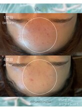 ポノ(Pono)/4回目のBefore/After☆