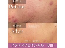 肌を整えたい！キープしたいなら！【プラズマフェイシャル】