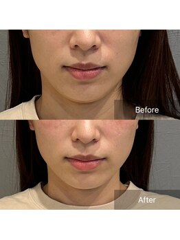 プライミー(PRIMY)/面長調節