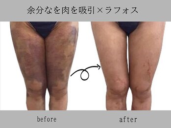 プレリー 自由が丘店/術後ケア　ラフォス