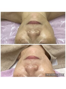 ルピナージュ(Lupinage)/ たるみ改善×小顔リフト