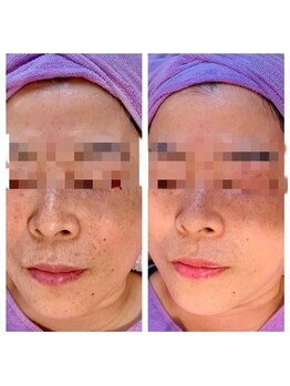 シープ(Sheep)/施術例3(シミ緩和)