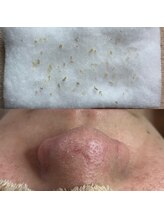 ビューティーネイル(Beauty Nail)/毛穴エクストラクション