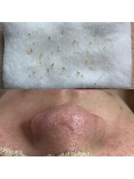 ビューティーネイル(Beauty Nail)/毛穴エクストラクション