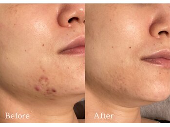 綺麗サロン 脱毛アンドフェイシャル ジュエル(Jewel)/【4BミネラルクリアTR】