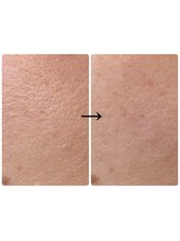 ネオズエゴ アーチ(neos ego Archi)/毛穴集中トリートメント