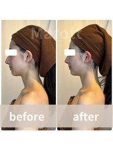 マロット 表参道店(Marott)/【20代女性】瞬間小顔リフト♪