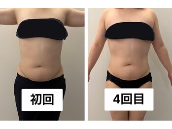 ナチュラル ユース(Natural youth)/ウエストと下腹部の変化