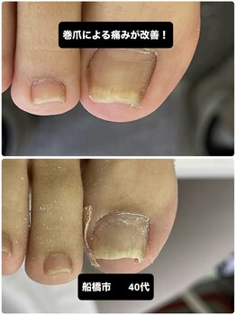 巻き爪じゅん 千葉駅前店/専門矯正で不安がすっきり！