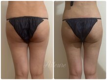 エルール トータルビューティ(Aileure total beauty)/インディバ+アミノ酸+燃焼ジェル