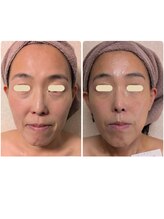 プライベートサロン 美月/ほうれい線　シワ　エイジング