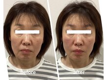 スリー治療院 伏見桃山(THREE治療院)/【ほうれい線改善】小顔矯正