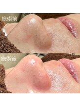 エクラ バイ シャンリィ(eclat by shanLy)/黒ずみ解消