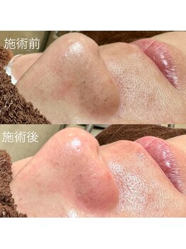 エクラ バイ シャンリィ(eclat by shanLy)/黒ずみ解消