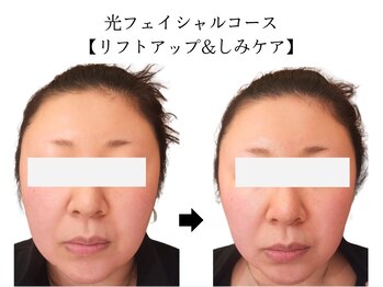 ヴィセル(VISEL)/小顔矯正&光フェイシャル