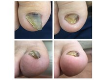 厚木 海老名 巻き爪矯正センター/事例【ツメフラ法巻き爪矯正】