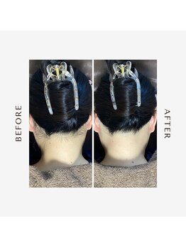 ラグレ(LUXRE)/うなじ脱毛