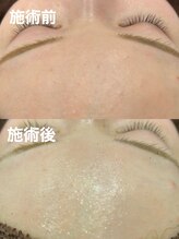 ツール(TOOL)/ハーブピーリング