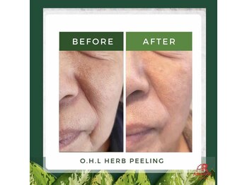 ラプリ 仙台店(Raplit stella)/ハーブピーリング/ニキビケア