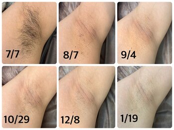 リュエル(RUELLE)/脇脱毛・全身脱毛・部分脱毛