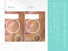 ルナティアラ(LUNAティアラ)/男性ニキビ・乾燥