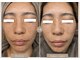 毛穴・肌質改善専門 private salon har’e【ハレ】　ピーリング/小顔の写真/【毛穴・肌質改善に特化】ニキビ・敏感肌も怖くない！お肌悩みを根本から改善し、ノーファンデ素肌美人へ☆