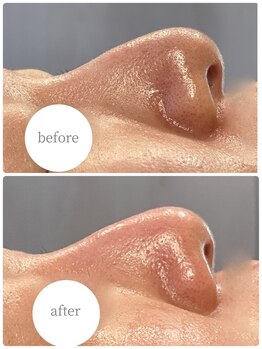 ハーシークレット(Her secret)/ハイドラ毛穴洗浄