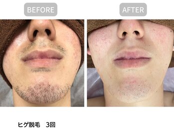 サロン ルーシュ(salon ruche)/脱毛(ひげ)