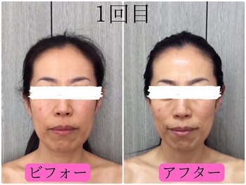 ソエルテ(soerute)/１回で別人！小顔筋膜リフト