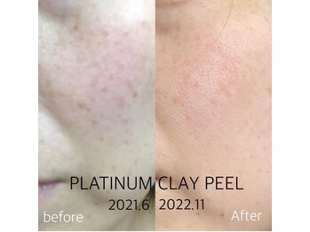 キャス(KYAS)/エイジングケアにはプラチナ！！