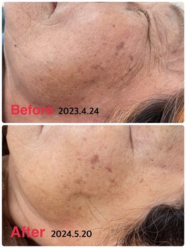 ソレイユ/80歳☆光フェイシャル