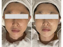 プライベートエステティックサロン クール(Coeur)/【光deたるみ改善引締めコース】