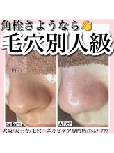 アルムダアクア 天王寺店(Aleumda AQUA)/ハーブピーリング/大阪/天王寺