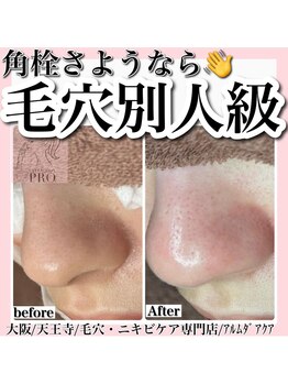 アルムダアクア 天王寺店(Aleumda AQUA)/ハーブピーリング/大阪/天王寺