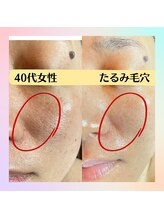 グラチア(Gratiae)/40代/ほうれい線たるみ毛穴改善