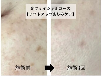 ヴィセル(VISEL)/光フェイシャルコース