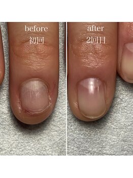 深爪矯正初回～2回目