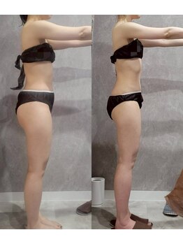 ユニ(uni.)/痩身症例