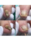 【巻き爪/陥入爪】