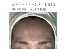 ヴィヴ 熊本(ViV)/【セルマンピーリング】after