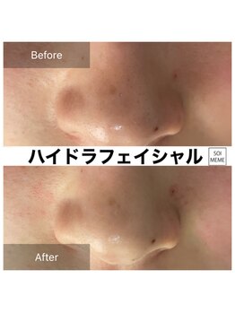 ビテキサロン ソワメーム(biteki salon SOI-MEME)/ハイドラフェイシャル