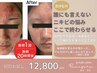 【8月人気】繰り返すニキビケア◎ピーリング×細胞アプローチ　初回お試し