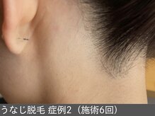 オアシスラグーン(OASIS LAGOON)/うなじ脱毛（症例2 施術6回）