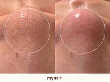 マイナプラ 表参道(myna+)の雰囲気（【プレミアム毛穴洗浄】特殊な角栓除去剤で毛穴汚れを吸引！）