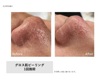 リエリカ 町田(Rerika)の写真/毛穴の開き・黒ずみ・ブツブツを即効ケア！全世代の肌質改善に♪毛穴レスで自信の持てる素肌へ導きます。